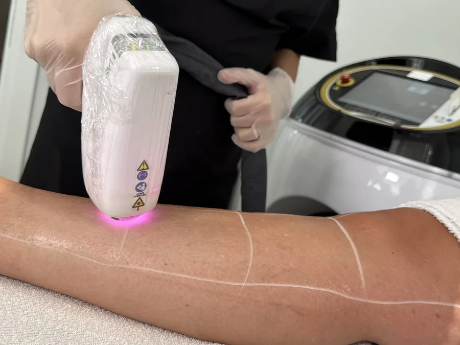 Epilazione laser su gamba in cabina